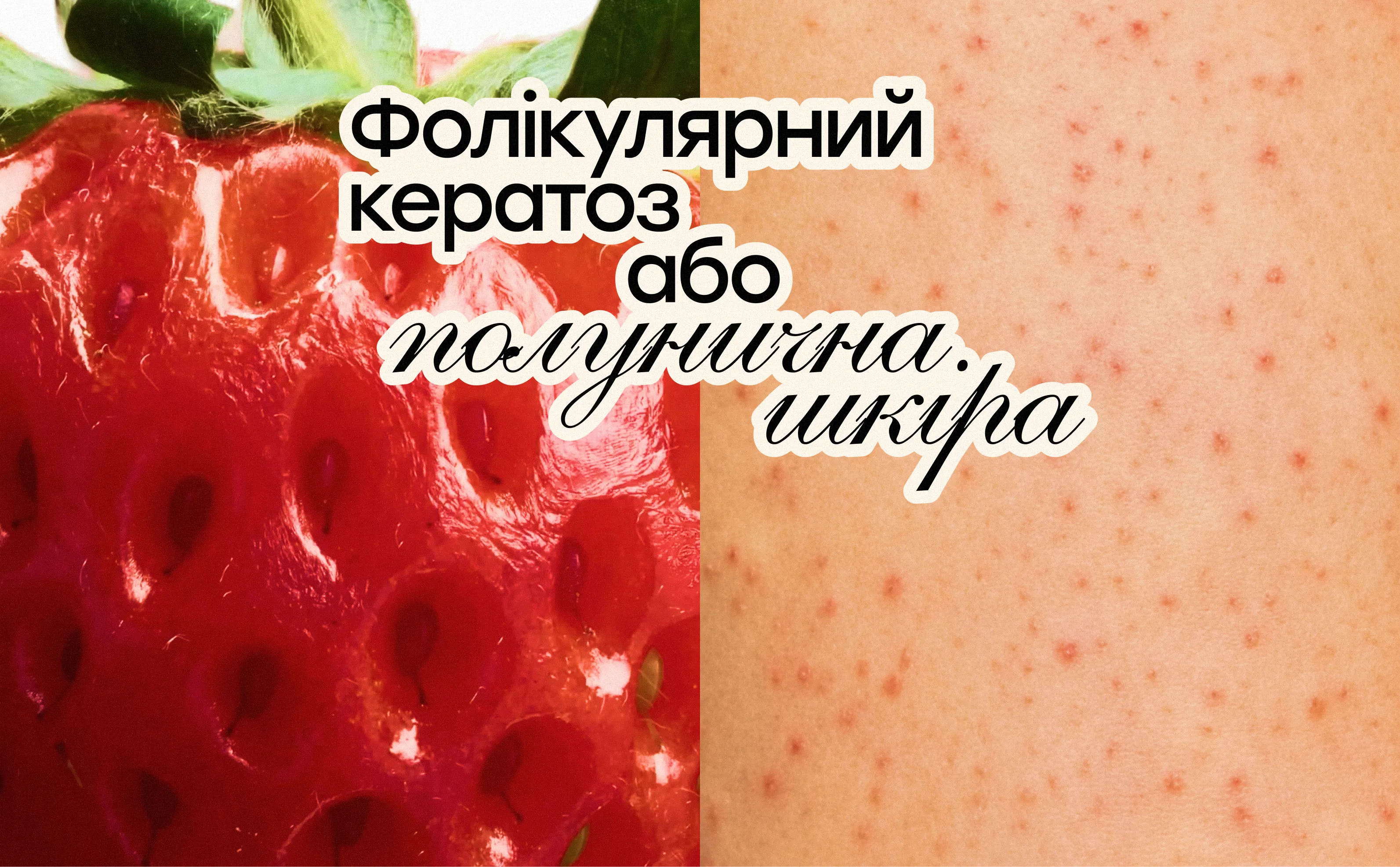 Полунична шкіра: що потрібно знати про фолікулярний кератоз