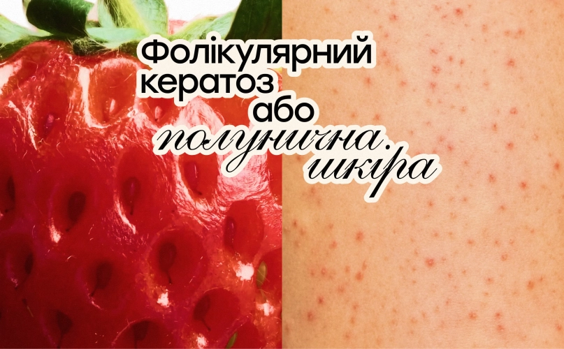 Полунична шкіра: що потрібно знати про фолікулярний кератоз 