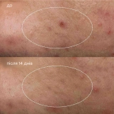 Рідкий пластир для лікування акне Deep Аcne Invisible Liquid Patch DERMALOGICA Обʼєм 15 мл — фото 5