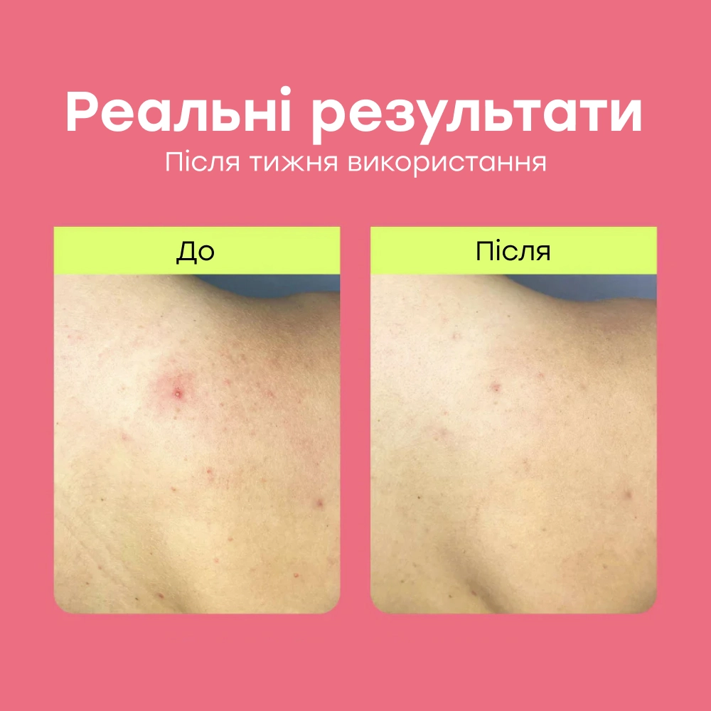 Спрей для тела против высыпаний и акне Clear Start Clarifying Body Spray DERMALOGICA Объем 177 мл — фото 5