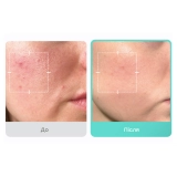 Успокаивающая сыворотка с азелаиновой кислотой 16% Azelaic Acid 16 BB Calming Serum MEDICUBE Объем 30 мл — фото 4