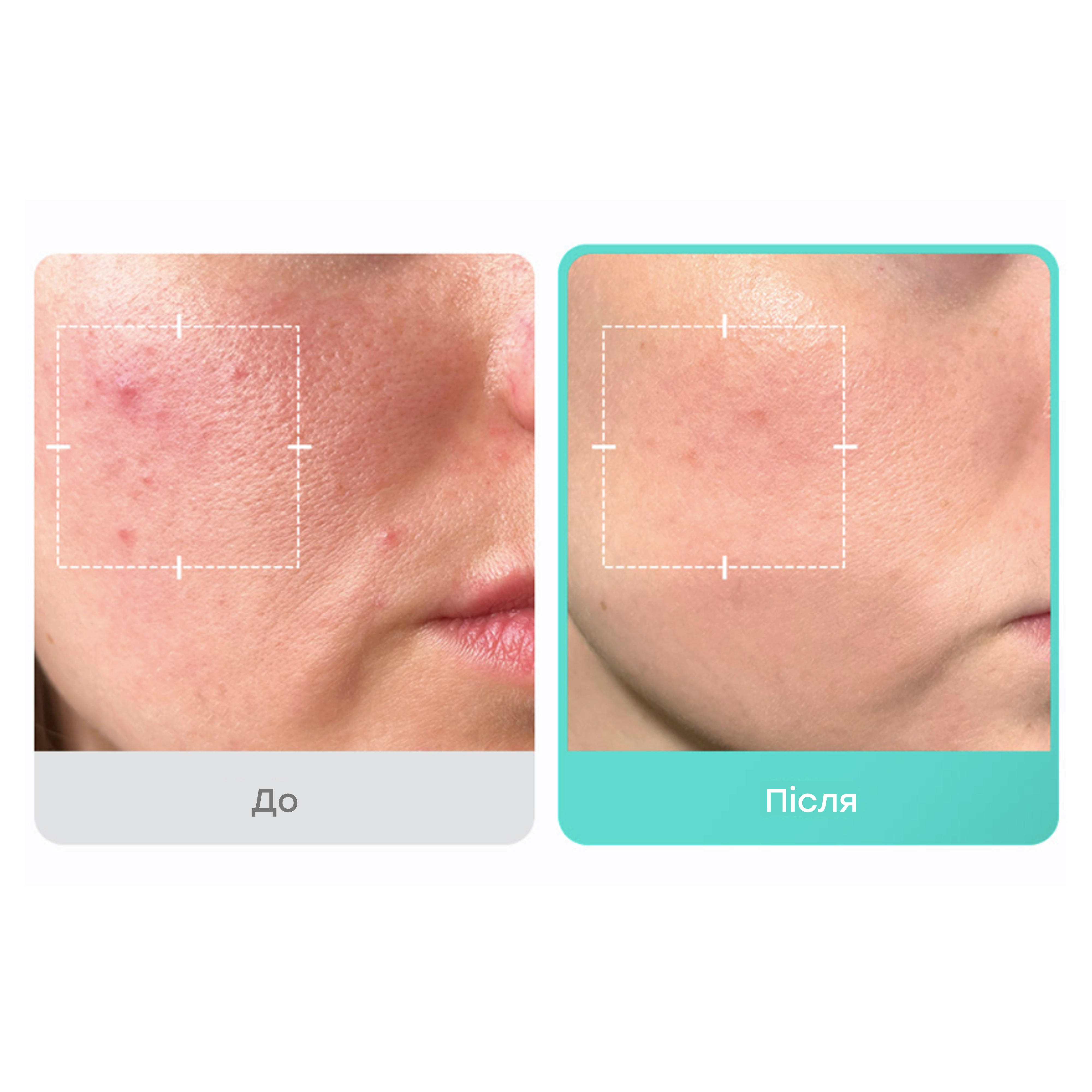 Успокаивающая сыворотка с азелаиновой кислотой 16% Azelaic Acid 16 BB Calming Serum MEDICUBE Объем 30 мл — фото 4