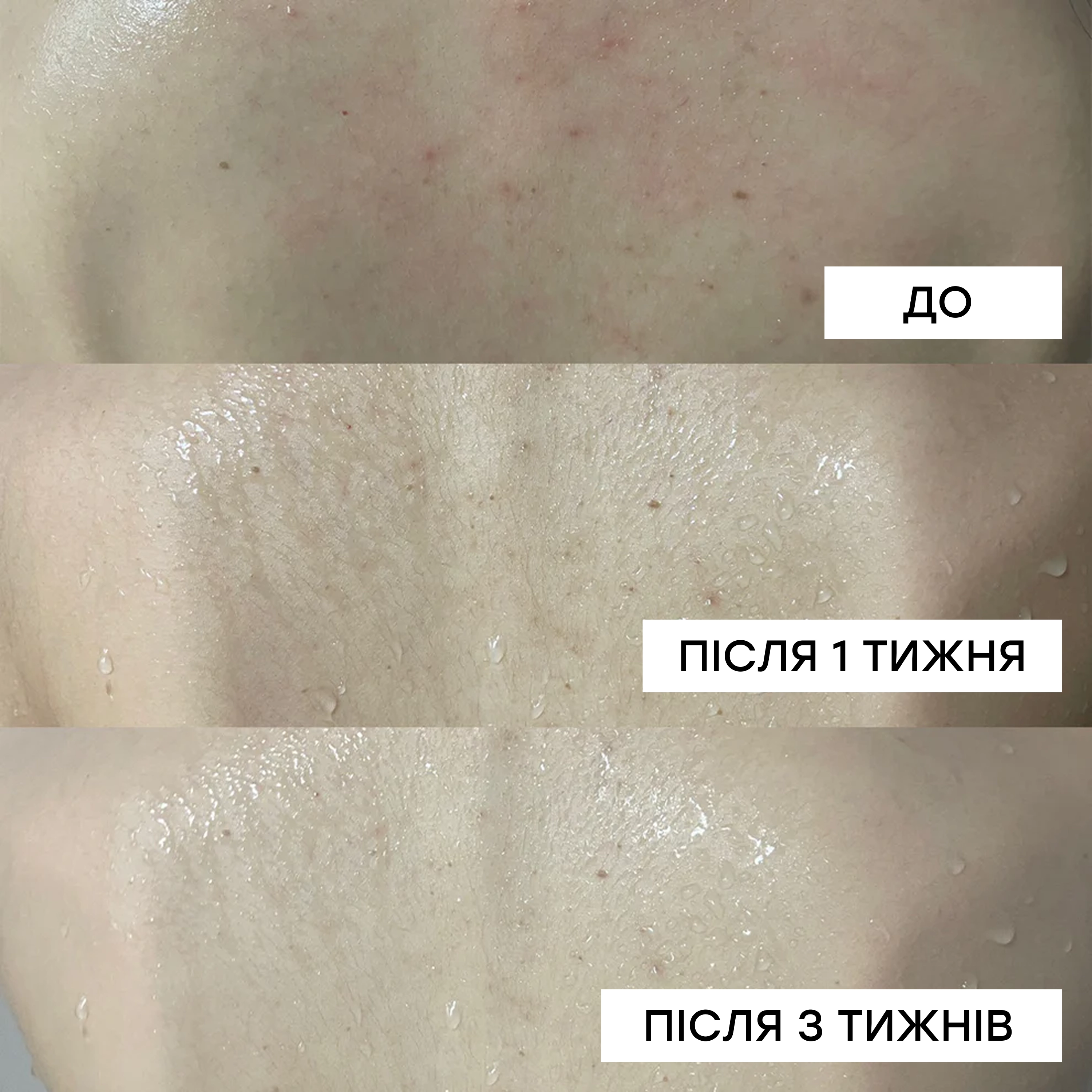 Протизапальний гель для душу з кислотами Red Acne Body Wash MEDICUBE Обʼєм 400 мл — фото 8