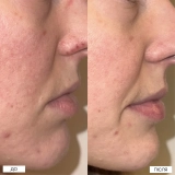 Локальний засіб з 10% азелаїновою кислотою проти висипань The Spot Solution – 10% Azelaic Acid Treatment MANTLE Обʼєм 30 мл — фото 4
