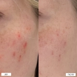 Локальний засіб з 10% азелаїновою кислотою проти висипань The Spot Solution – 10% Azelaic Acid Treatment MANTLE Обʼєм 30 мл — фото 5
