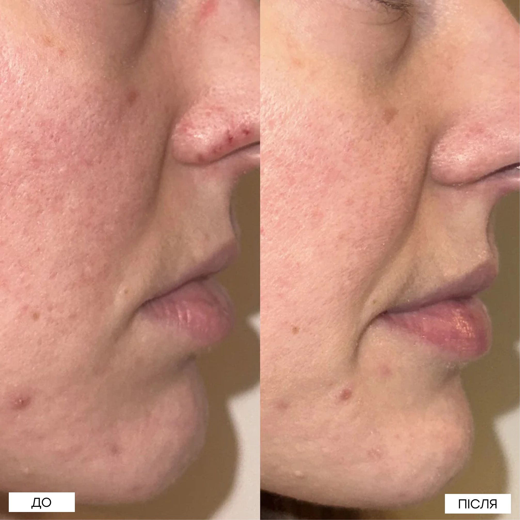 Локальний засіб з 10% азелаїновою кислотою проти висипань The Spot Solution – 10% Azelaic Acid Treatment MANTLE Обʼєм 30 мл — фото 4