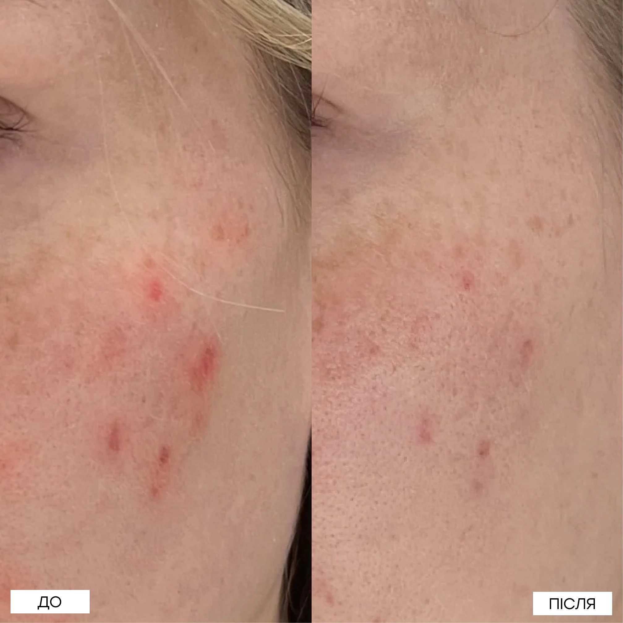 Локальний засіб з 10% азелаїновою кислотою проти висипань The Spot Solution – 10% Azelaic Acid Treatment MANTLE Обʼєм 30 мл — фото 5