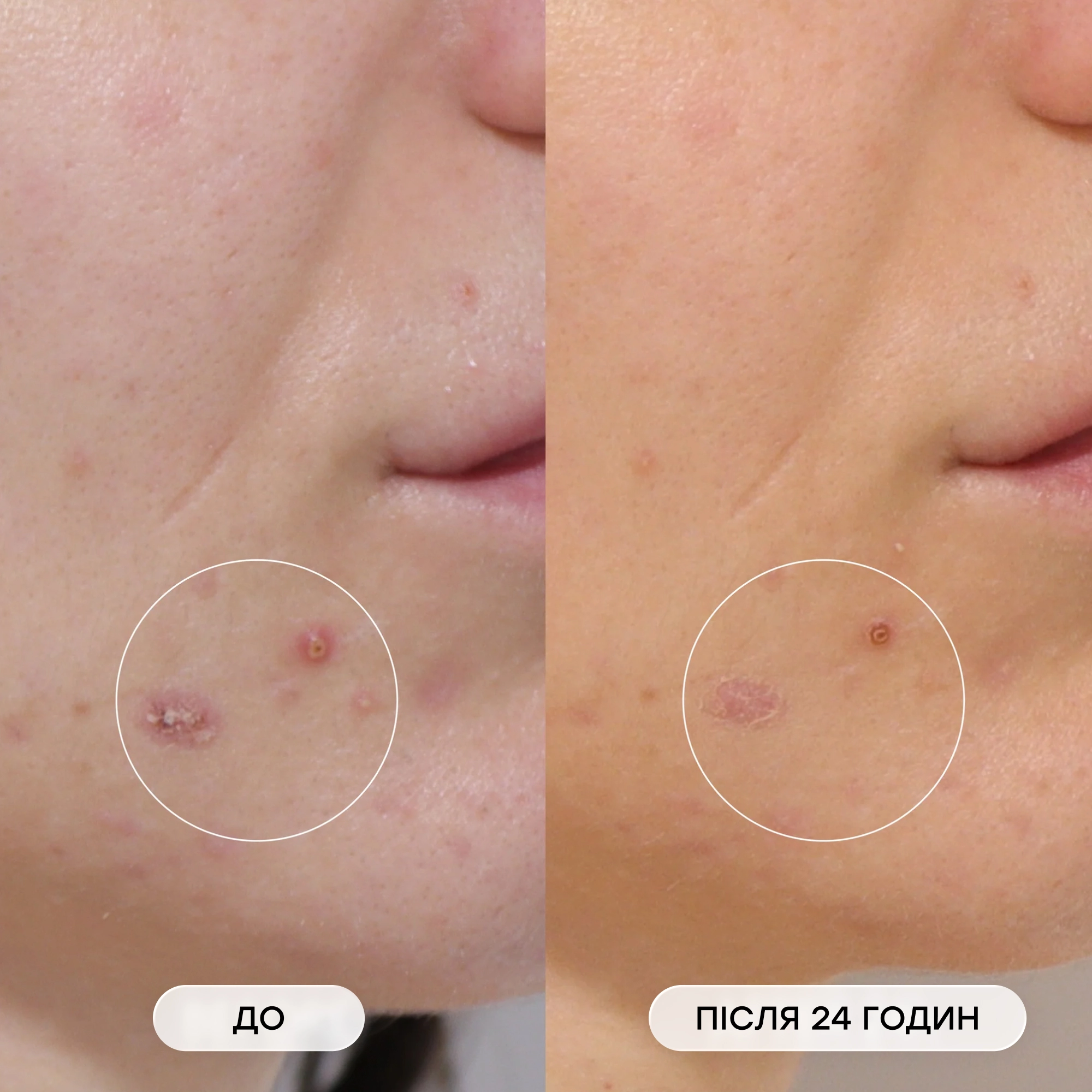 Мікроголкові патчі для зони підборіддя проти висипань Microneedle Jaw Mask Set MASQMAI — фото 5