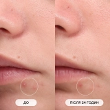 Мікроголкові патчі проти висипань Microneedle Pimple Patch Set MASQMAI — фото 5